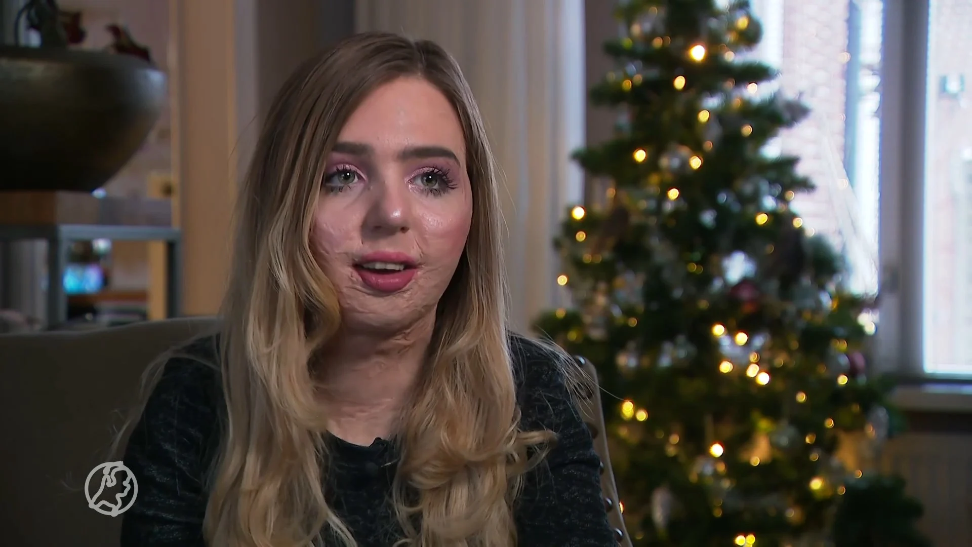 Marjolein is voor 69 procent verbrand door een kerstkaars: 'Brand zit in klein hoekje'