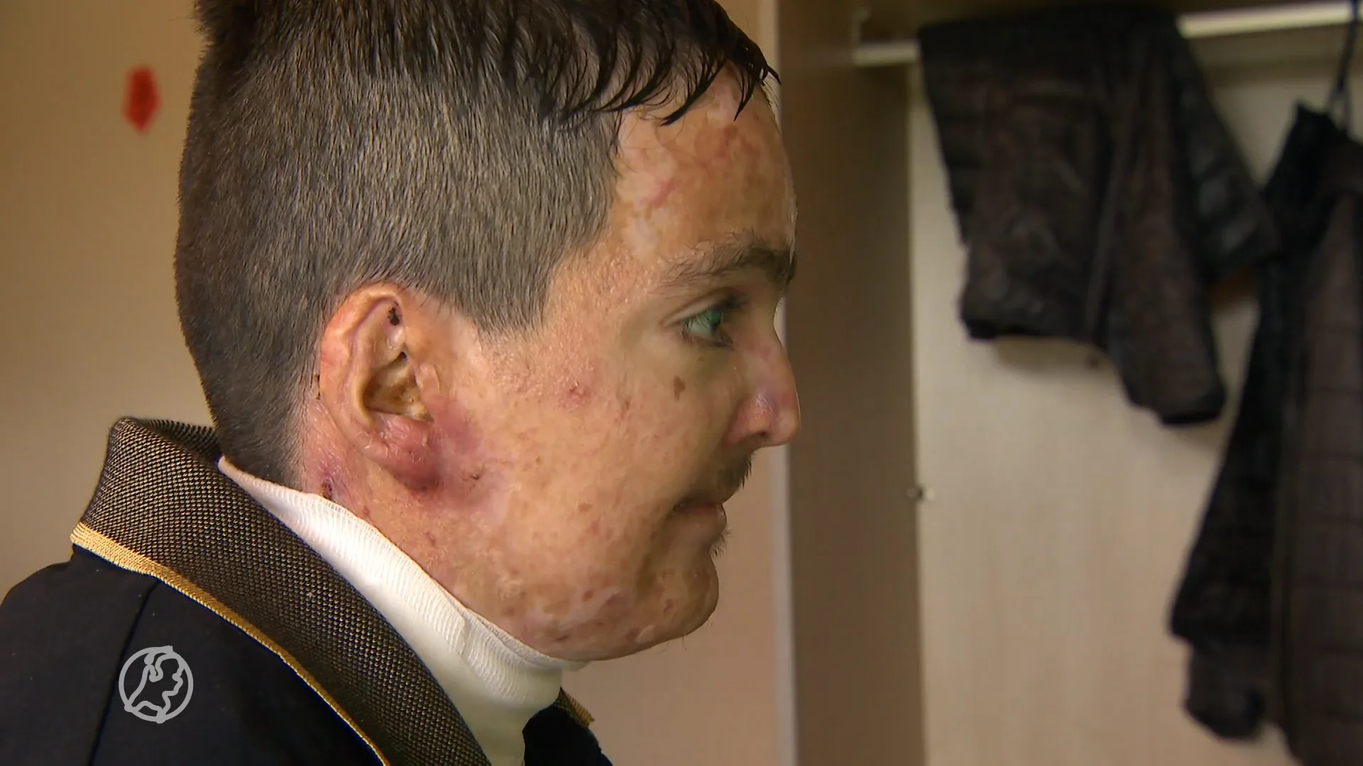 Nieuwe zalf biedt hoop voor Shivan: vlinderziekte beter te behandelen