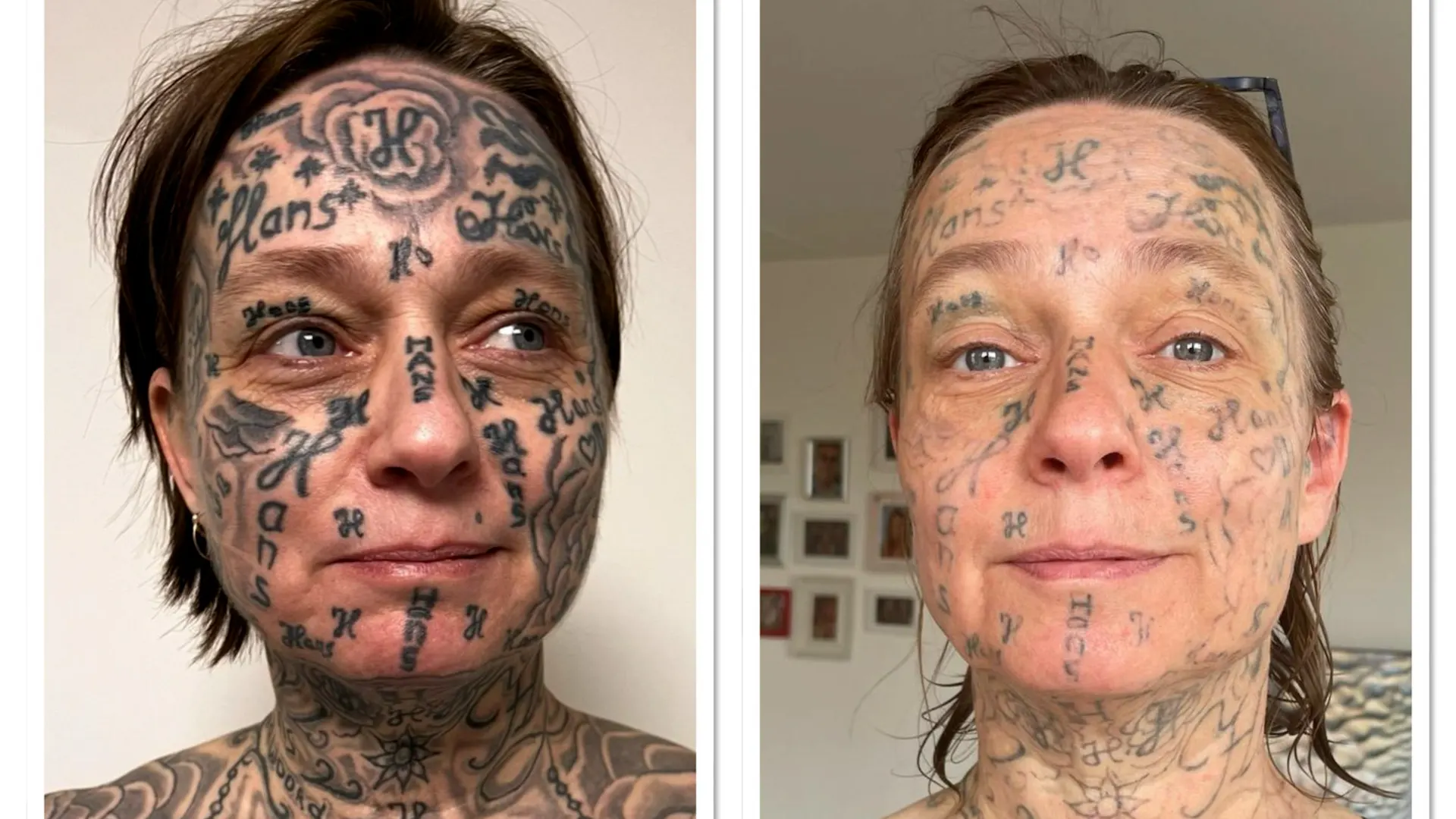 Andy is al anderhalf jaar bezig om de tattoo's op Joke haar lichaam te verwijderen Beeld: privé