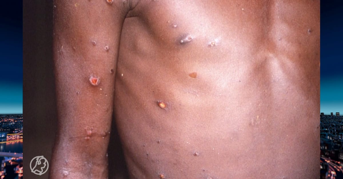 Un avvertimento internazionale da parte dell'Organizzazione Mondiale della Sanità dopo un'epidemia di vaiolo delle scimmie in Congo