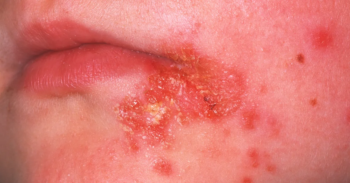 Rise in Kids Visiting Doctors with Acne, More Mysterious Symptoms Reported - News Directory 3